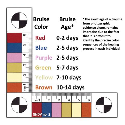 A standardized color scale was the basis for the determination of the